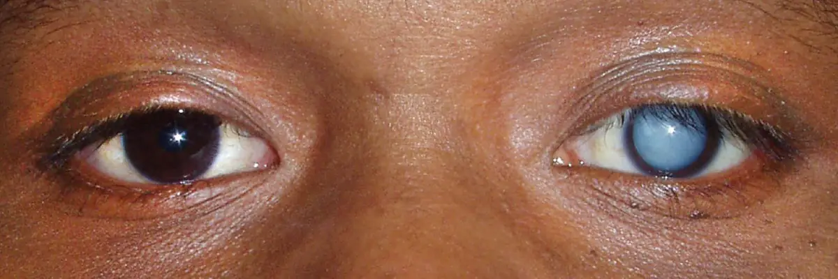 Two eyes side by side: a healthy dark pupil on the left and a cloudy white-blue cataract on the right