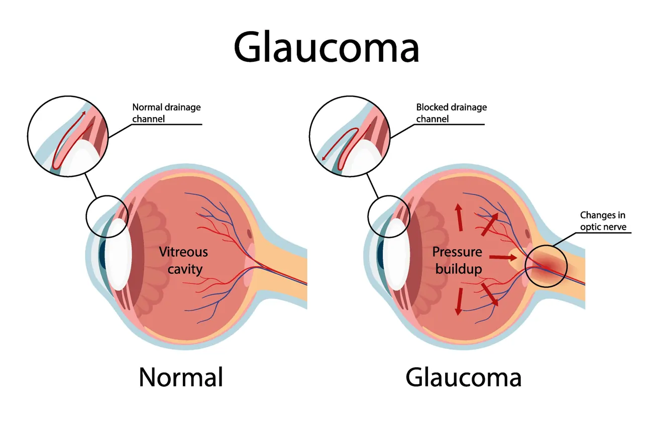 Diagram comparing a normal eye with open drainage channel and a glaucoma eye with blocked drainage, pressure buildup and optic nerve changes